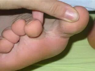 Toes