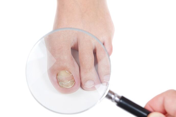 Fungal nails under a magnifying glass