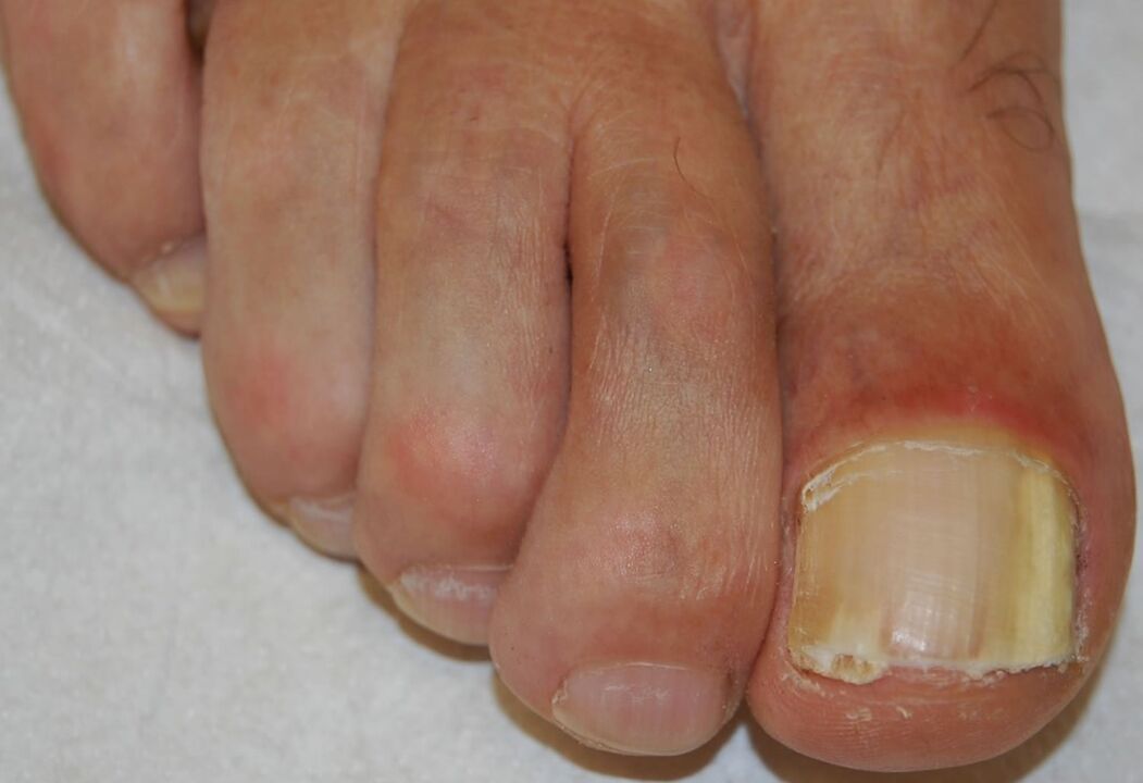 Distal-lateral subungual onychomycosis of the foot