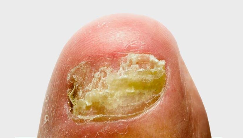 stages of nail fungus development